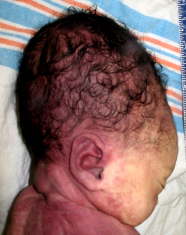 4A2 Hydranencephaly (Case 4) 2