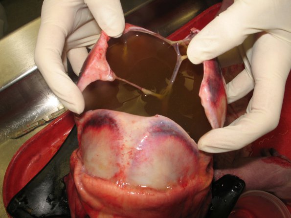 4B1 Hydranencephaly (Case 4) 4