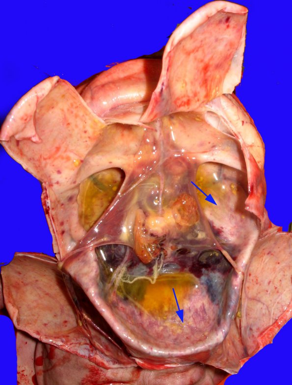 4B3 Hydranencephaly (Case 4) 7