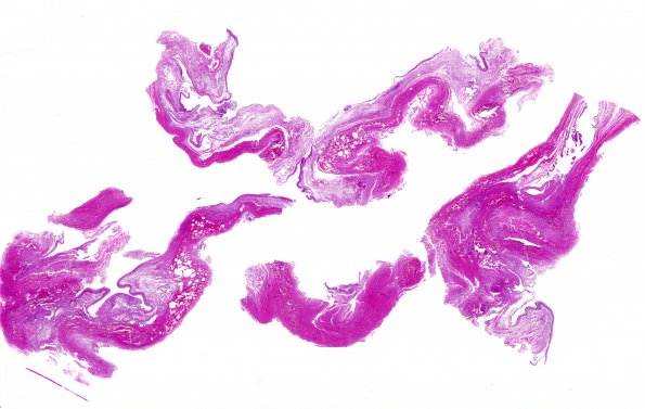 4C1 Hydranencephaly (Case 4) N6 dura & brain H&E whole mount