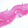 4C2 Hydranencephaly (Case 4) N6 dura & brain H&E 8