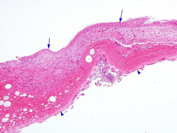 4C2 Hydranencephaly (Case 4) N6 dura & brain H&E 8