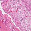 4C3 Hydranencephaly (Case 4) N6 dura & brain H&E 3