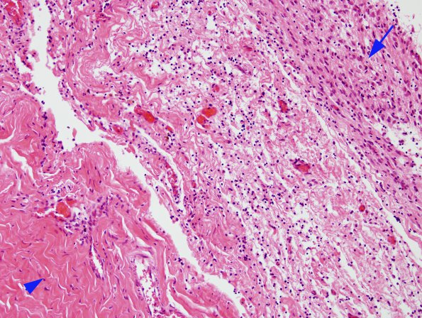 4C3 Hydranencephaly (Case 4) N6 dura & brain H&E 3