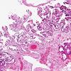 4C4 Hydranencephaly (Case 4) residual fragments brain H&E 11