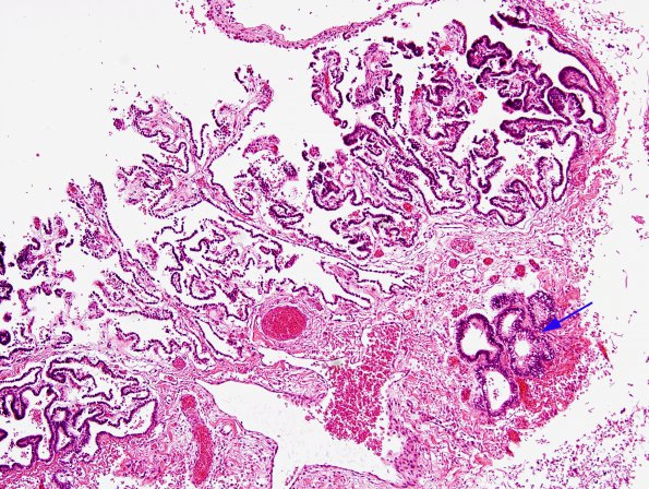 4C4 Hydranencephaly (Case 4) residual fragments brain H&E 11