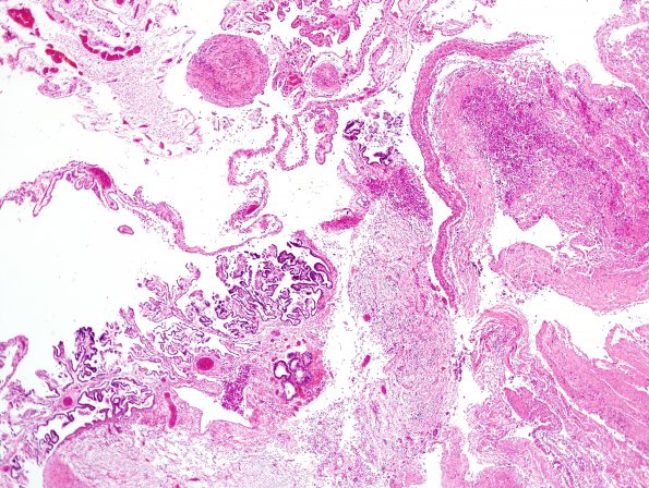 4C5 Hydranencephaly (Case 4) residual fragments brain H&E 18