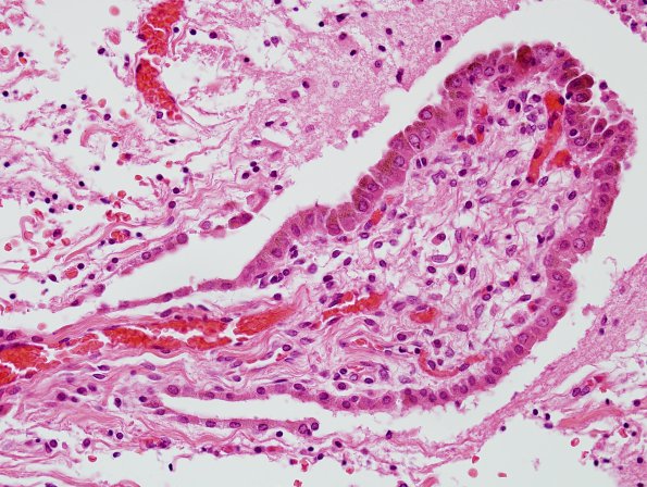 4C7 Hydranencephaly (Case 4) residual fragments brain H&E 16