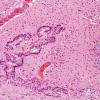 4C8 Hydranencephaly (Case 4) residual fragments brain H&E 14