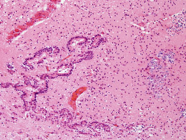 4C8 Hydranencephaly (Case 4) residual fragments brain H&E 14