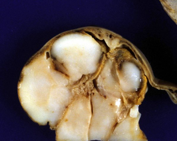 5A3 Hydranencephaly (Case 5) 8