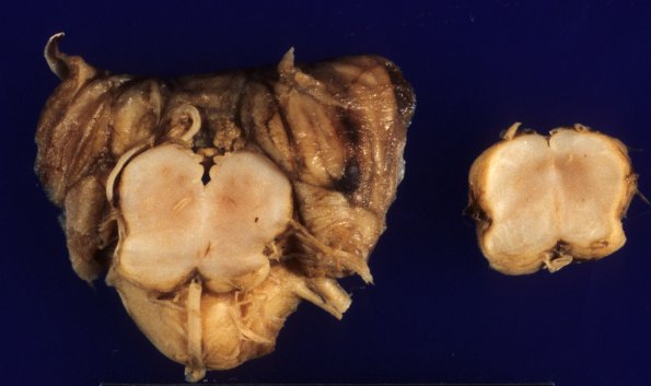 5A4 Hydranencephaly (Case 5) 2