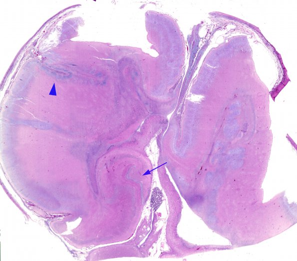 5B1 Hydranencephaly (Case 5) H&E 1