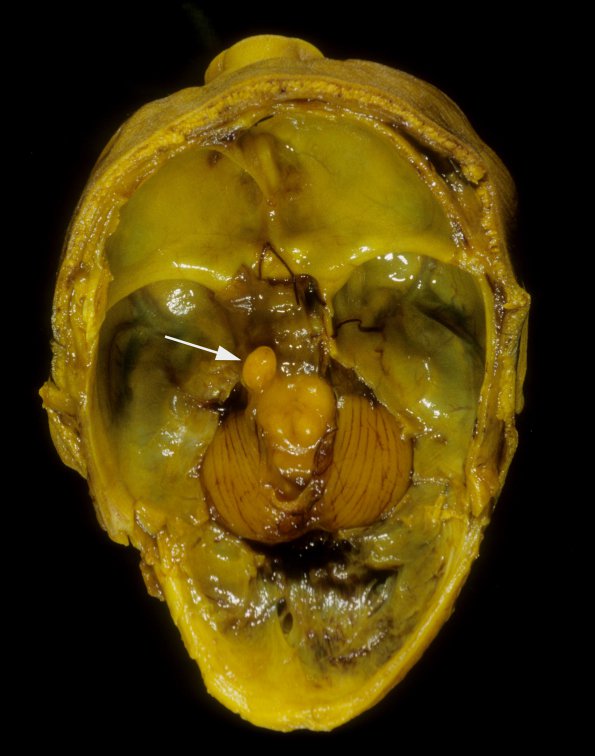 6A2 Hydranencephaly  (Case 6) A3