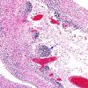 6B3 Hydranencephaly  (Case 6) A3A