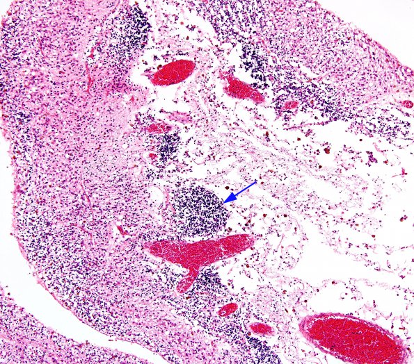 6B3 Hydranencephaly  (Case 6) A3A