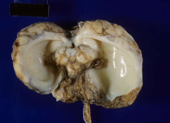 7 Hydranencephaly (Case 7) 1