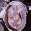 8B Hydranencephaly (Case 8) 1