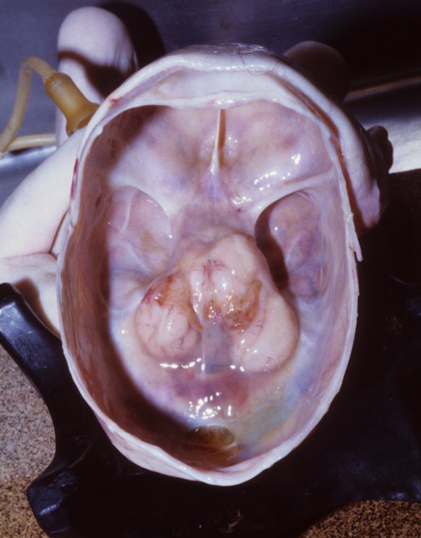 8B Hydranencephaly (Case 8) 1