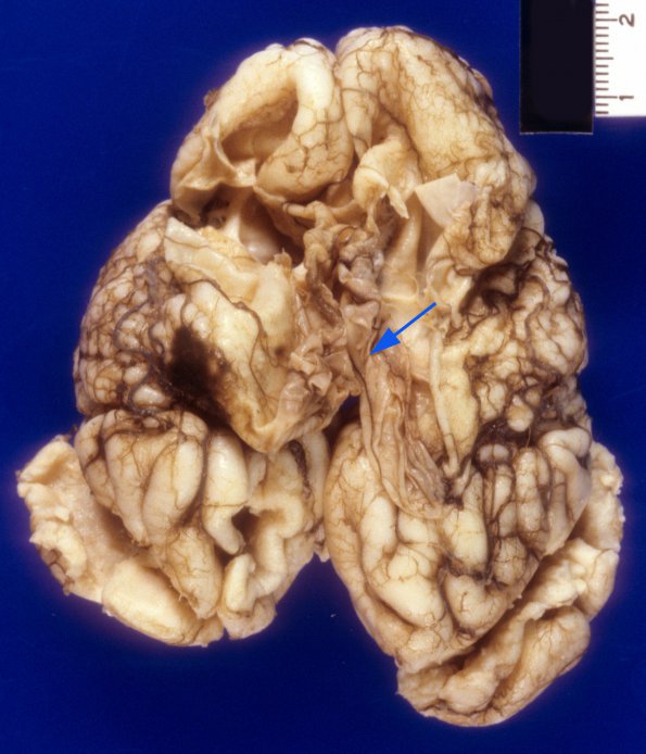 9A1 Hydranencephaly, PMG, Neonatal HSV-II, survived 4 mo (Case 9) 4