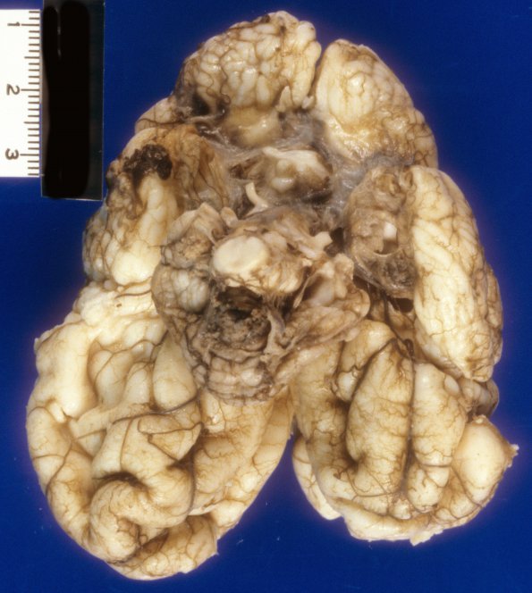 9A2 Hydranencephaly, PMG, Neonatal HSV-II, survived 4 mo (Case 9) 3