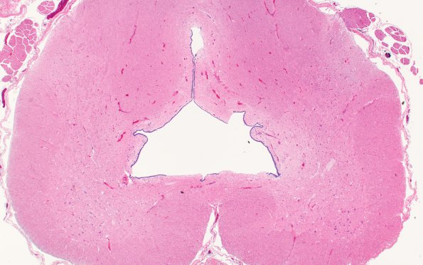 1B2 Hydromyelia (Case 1) N19 H&E 1 - Copy