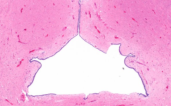 1B3 Hydromyelia (Case 1) N19 H&E 3 - Copy