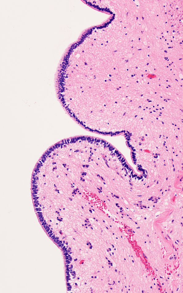 1B4 Hydromyelia (Case 1) N19 H&E 7 - Copy