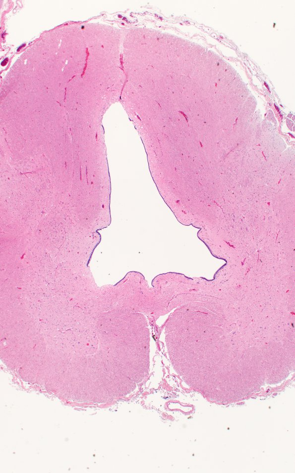 1B5 Hydromyelia (Case 1) N19 H&E 2 - Copy