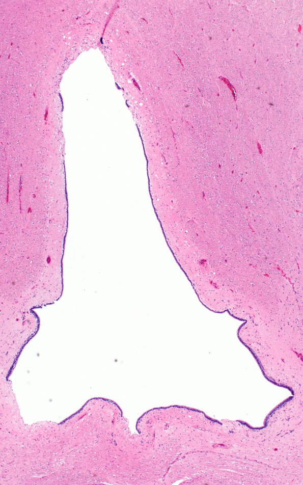 1B6 Hydromyelia (Case 1) N19 H&E 4 - Copy