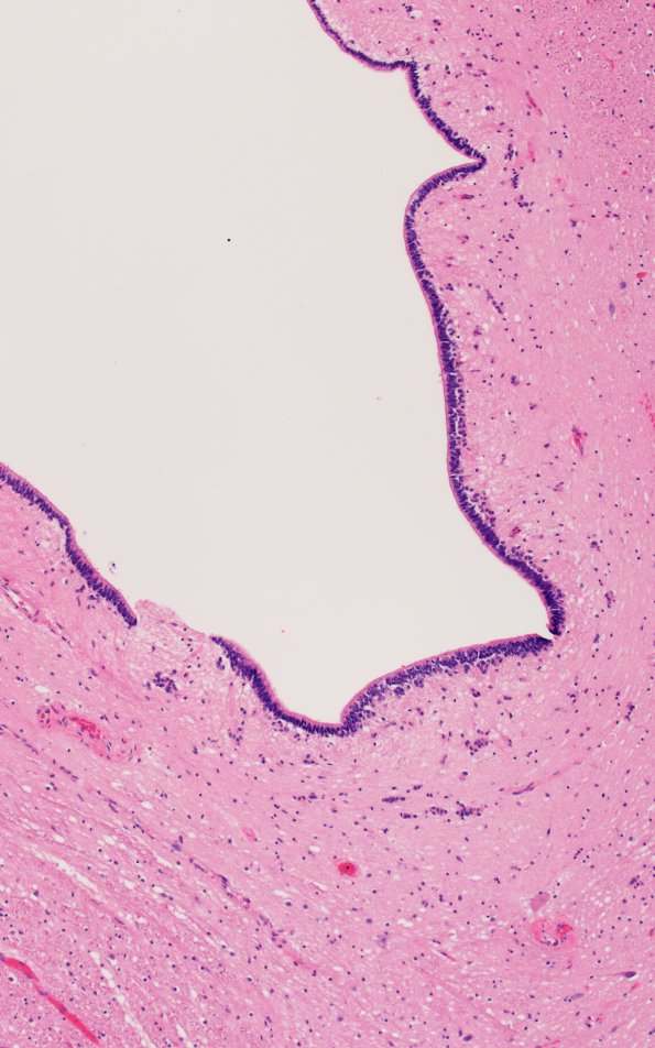 1B8 Hydromyelia (Case 1) N19 H&E 5 - Copy