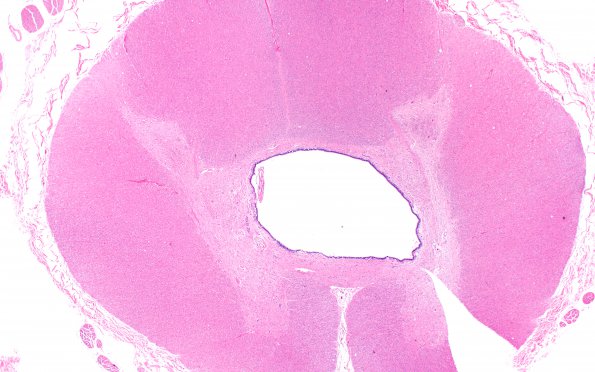 2B2 Hydromyelia (Case 2) N12 H&E 2X