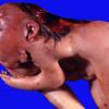 Iniencephaly