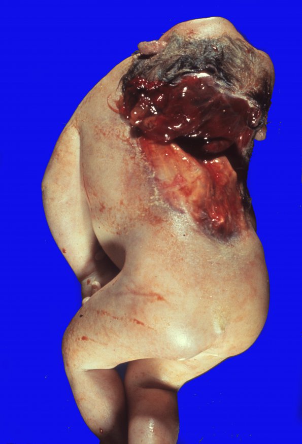 1B Iniencephaly (Case 1)