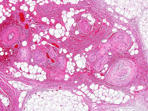 1A1 Localized Overgrowth-Macrodactyly (Case 1) H&E 2