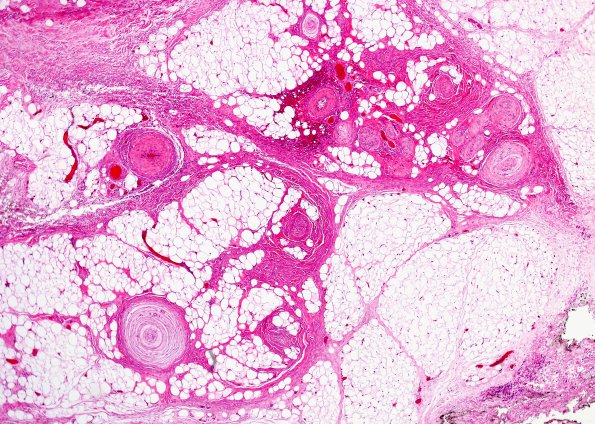 1A2 Localized Overgrowth-Macrodactyly (Case 1) H&E 3