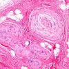 1A3 Localized Overgrowth-Macrodactyly (Case 1) H&E 1