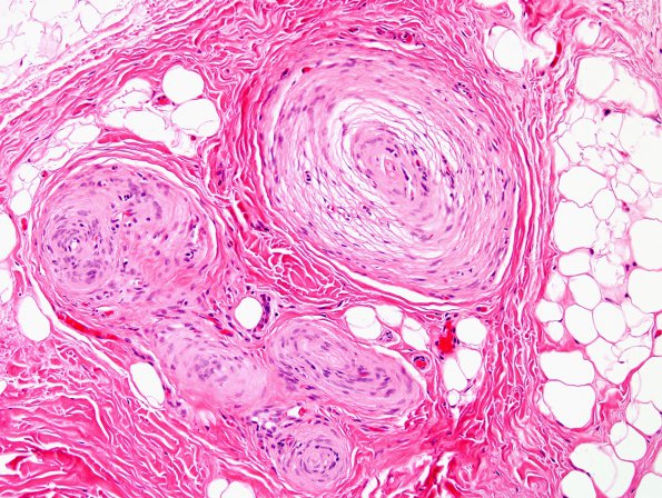 1A3 Localized Overgrowth-Macrodactyly (Case 1) H&E 1