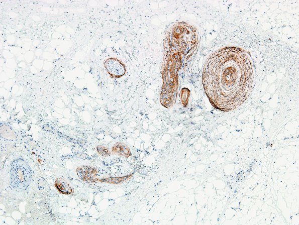 1A4 Localized Overgrowth-Macrodactyly (Case 1) EMA 1A