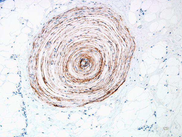 1B1 Localized Overgrowth-Macrodactyly (Case 1) EMA 2