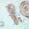 1B2 Localized Overgrowth-Macrodactyly (Case 1) EMA