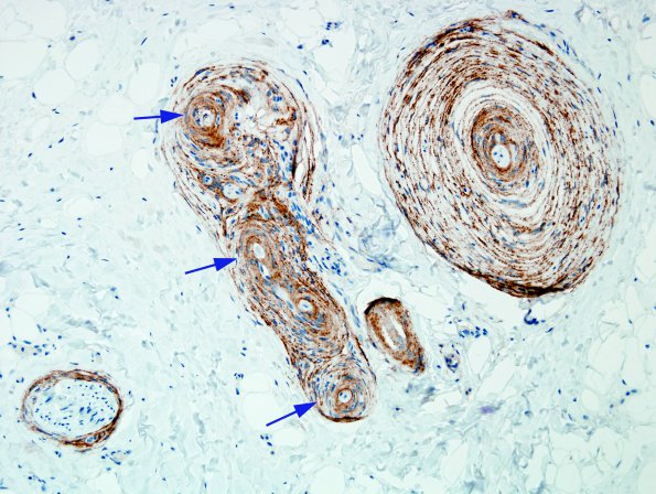 1B2 Localized Overgrowth-Macrodactyly (Case 1) EMA