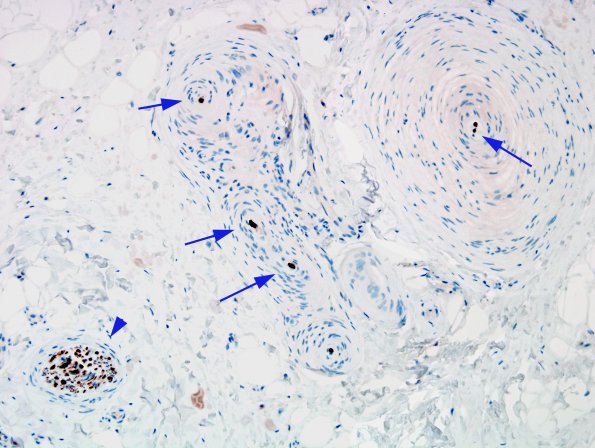 1B3 Localized Overgrowth-Macrodactyly (Case 1) NF