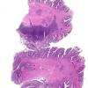 10A1 Cerebellum, Complex malformation (Case 10) 1 copy