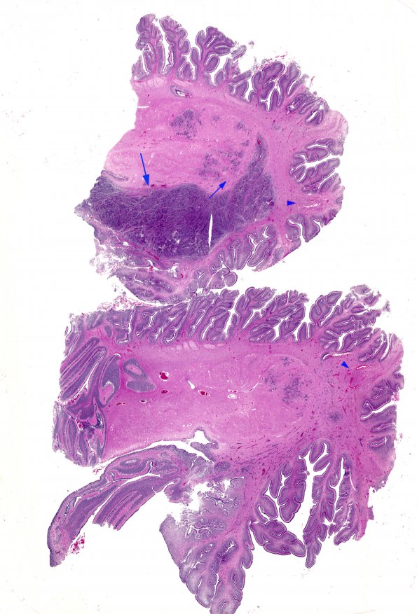 10A1 Cerebellum, Complex malformation (Case 10) 1 copy