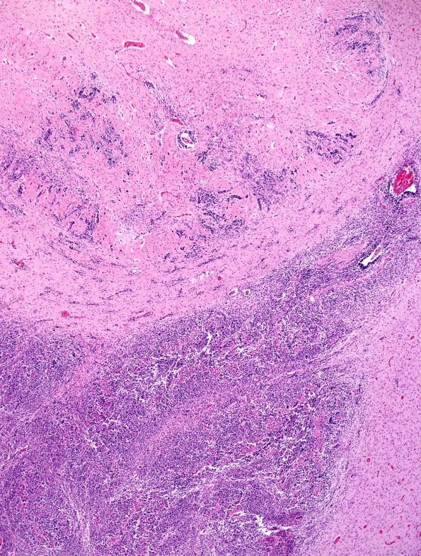 10A2 Cerebellum, Complex malformation (Case 10) 12