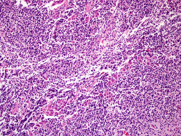 10A3 Cerebellum, Complex malformation (Case 10) 5