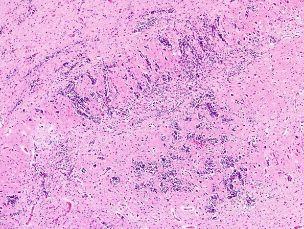 10A4 Cerebellum, Complex malformation (Case 10) 1810