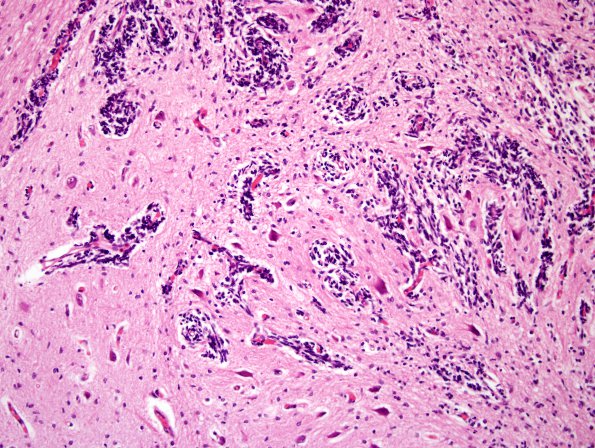 10A5 Cerebellum, Complex malformation (Case 10) 6