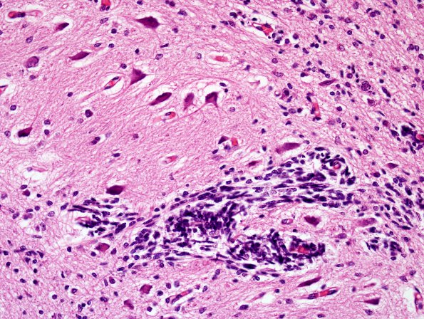 10A6 Cerebellum, Complex malformation (Case 10) 8